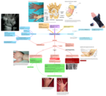 Scaphoide fracture
